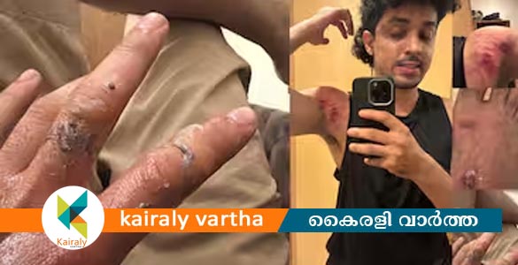 ആക്ഷന്‍ രംഗം ചിത്രീകരിക്കുന്നതിനിടെ അപകടം; നടന്‍ സാഗര്‍ സൂര്യയ്ക്ക് പരിക്ക്‌