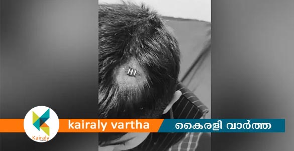 അധ്യാപിക ടിഫിൻ ബോക്സ് എറിഞ്ഞു; എൽകെജി വിദ്യാർഥിയുടെ തലക്ക് പരിക്ക്