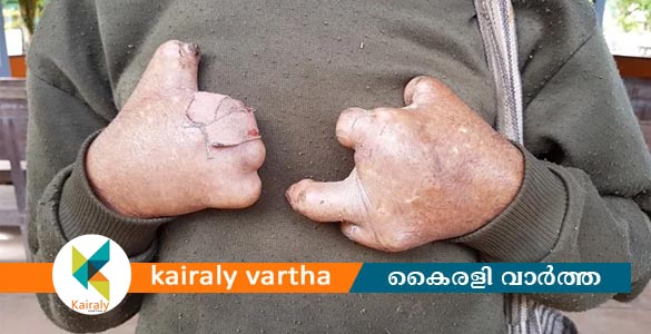 കുഷ്ഠരോഗ നിര്&zwj;ണയ ഭവനസന്ദര്&zwj;ശന യജ്ഞം 'അശ്വമേധം' ജനുവരി ഏഴു മുതല്&zwj;